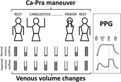 Quantitative analysis of venous outflow with photo-plethysmography in patients with suspected thoracic outlet syndrome